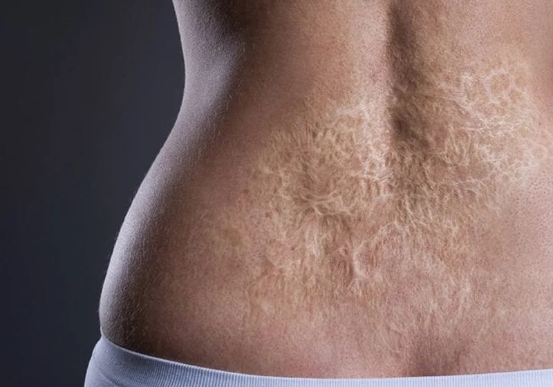 Injury scars treatment