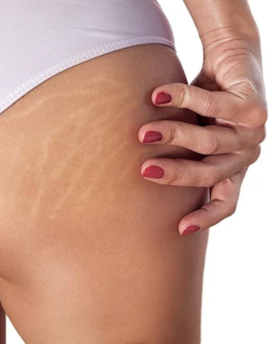 Stretch marks treatment