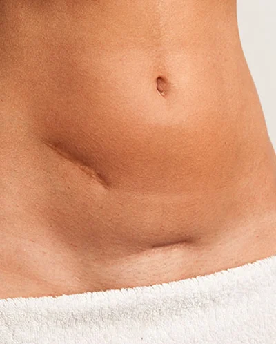 Surgical Scars treatment