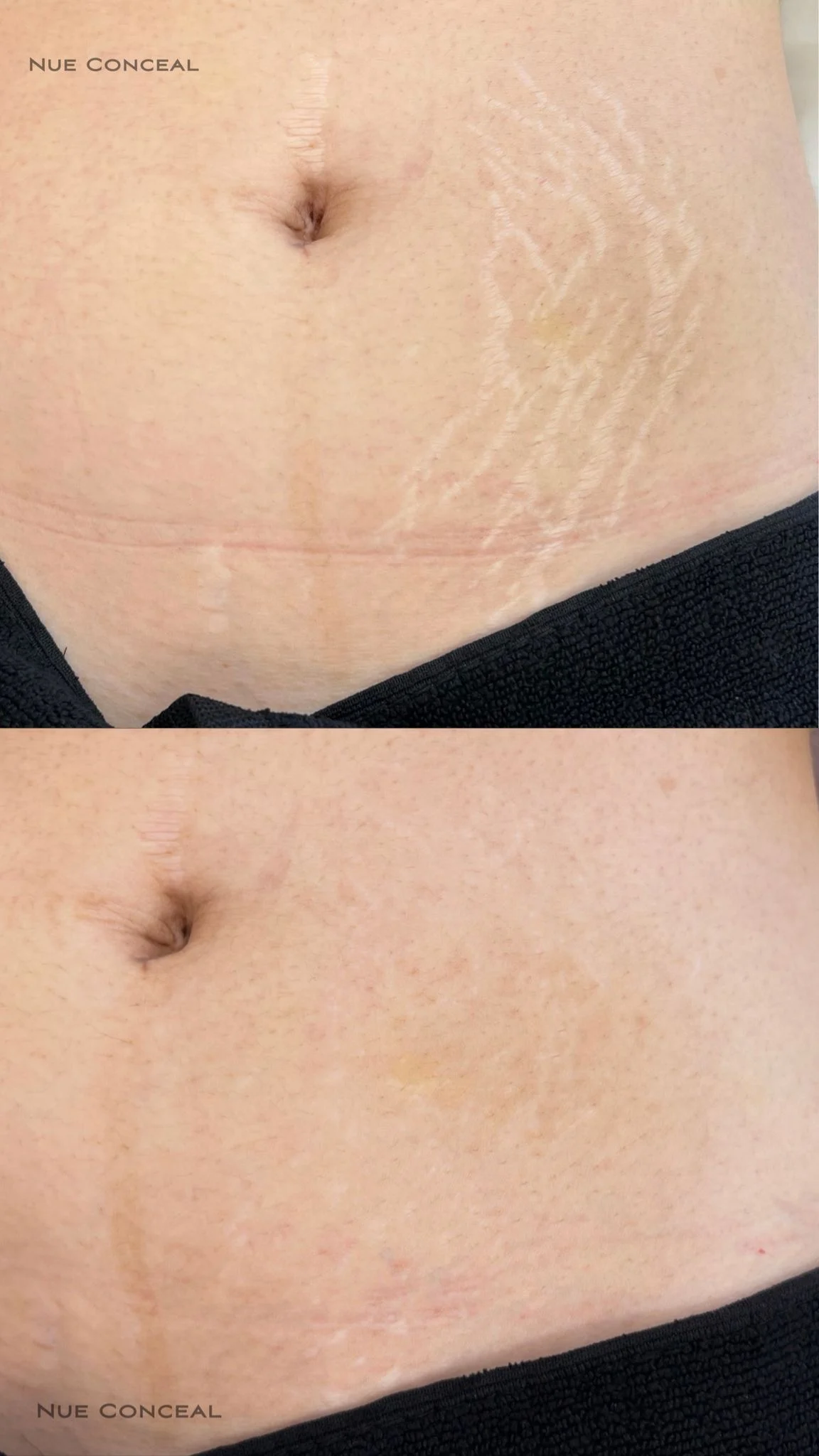 Stretch marks treatment